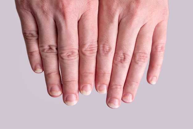 Лечение полосатых ногтей